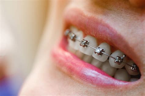 traditional and self ligating braces